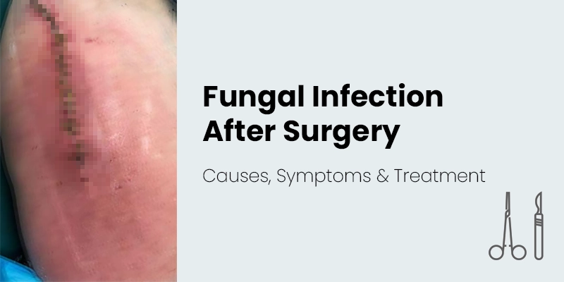 Fungal Infections After Surgery: Warning Signs, Causes, Treatment & Prevention Tips Service